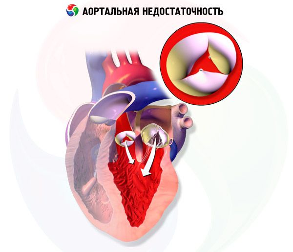 fogyás aorta szűkület)