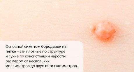 Szemölcs a sarkon: mit tegyek?