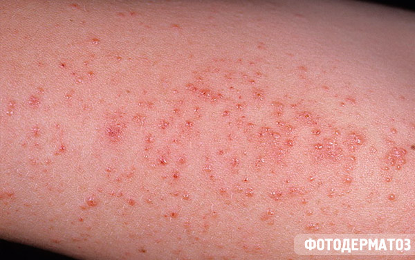 atopic dermatitis causes