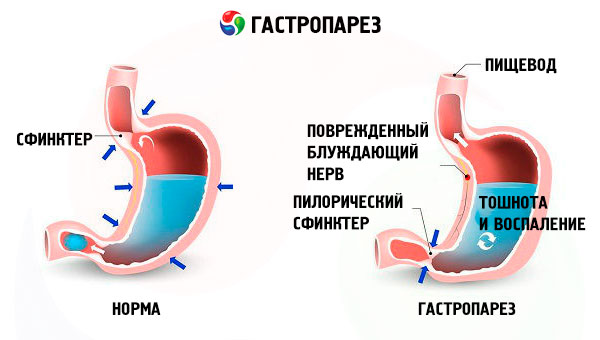 diabetes gastroparesis tünetei)
