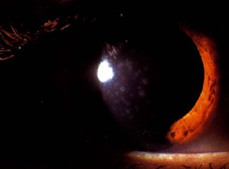 Epidémiás keratoconjunctivitis
