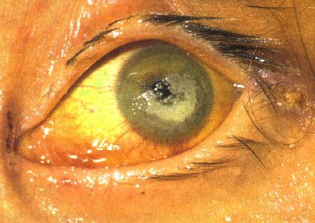 A Candida által okozott bilaterális keratitis súlyos immunhiányos gyermekeknél