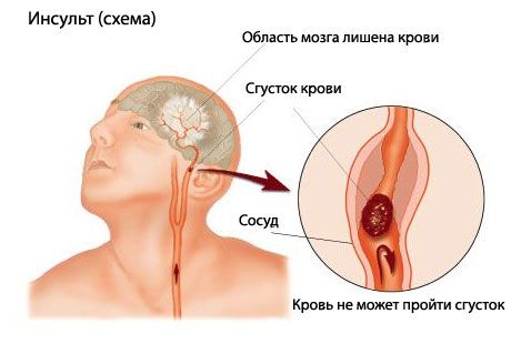 Egy egyszerű teszt előrejelzi a halálos stroke-ot