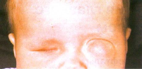 Mikroftalmus társuló cisztaképződéssel (bal szem). Anoftalmus (jobb szem).