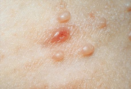 Molluscum contagiosum: fotók