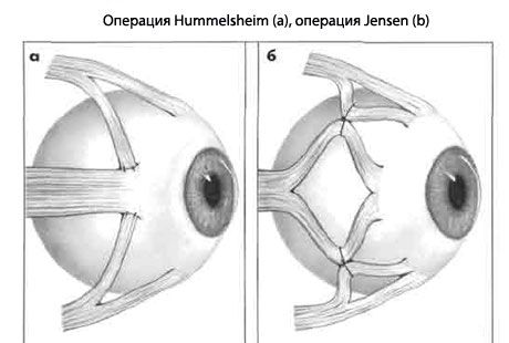 Strabismus - Működés