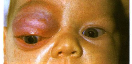 A keringő és a felső szemhéjak elülső része kapilláris hemangioma.  A daganat egyre inkább előrehalad