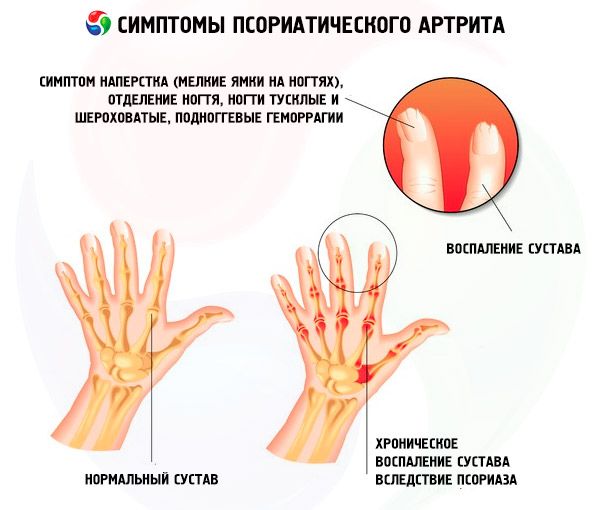 a térdízület ii fokú artrózisának kezelése 1 fokos kar kezelés artrózis