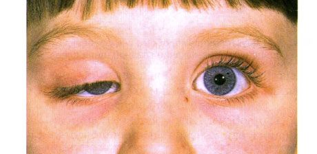 Egyoldali veleszületett ptosis