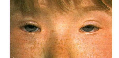Blepharophimosis szindróma. Kétoldali operált ptosis, telecanthus és blepharophimosis