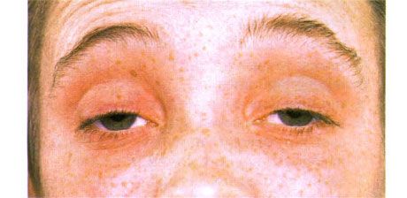 Külső szemölcs-bénulás. Kétoldali ptosis. A beteg a szemöldökét felvonva nyitja ki a szemét.