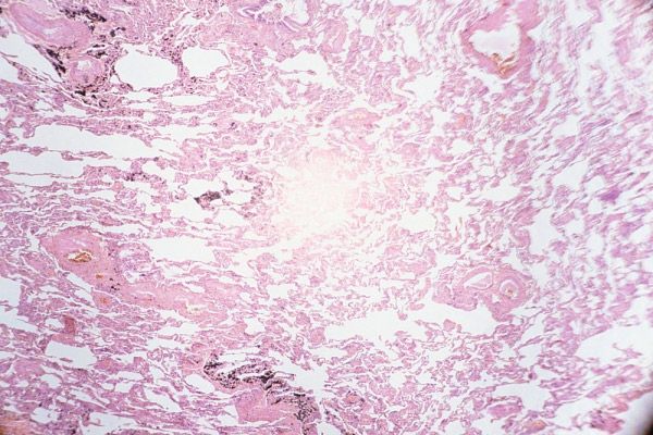 hármas negatív rák A hasnyálmirigyrák utolsó fázisának tünetei