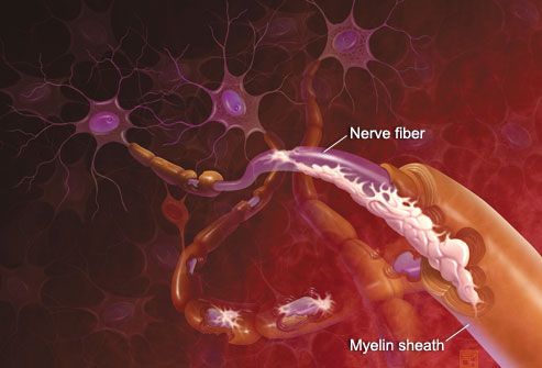 Hogyan működik a multiplex szklerózis