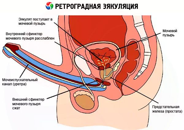Prostatitis és retrográd ejakuláció kevés spermium okai