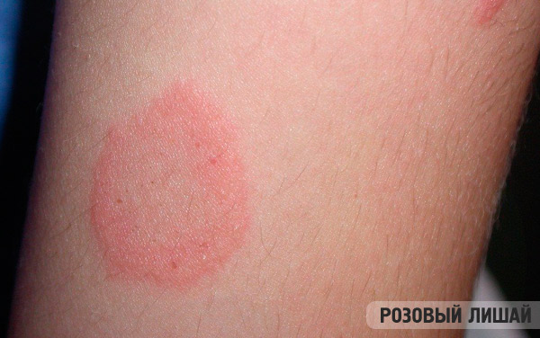 Piros kiütések a bőrön? 6 gyakori betegség, ami okozhatja