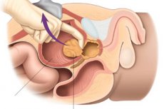 Komplikációk a prosztata reszekció után A prosztatitis gyulladásának okai a férfiaknál