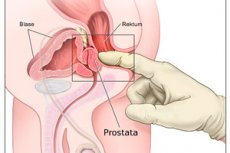 prosztata masszázs technika Krónikus prosztatitis 20 év