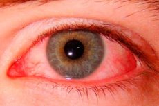 piros könnyező szem buja anti aging