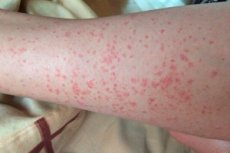 Bőrtünetek - A cukorbetegség első jelei lehetnek Vörös foltok a lábakon a borjakon