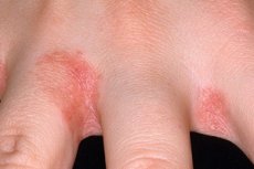 dermatitis érintkezés az ujjak között