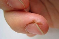 repedt kezelés ujjak cukorbetegség