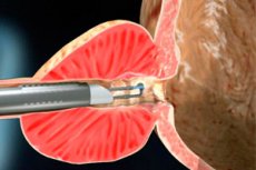 Megnagyobbodott prosztata kezelése | Lézerek az orvostudományban