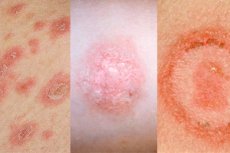 Milyen betegségre utalnak a vörös foltok? - HáziPatika