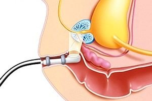 Prostatitis 4 szakasz
