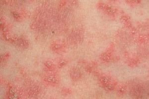 imunofan pikkelysömör kezelésére vörös bőrfoltok a bőrön okozzák