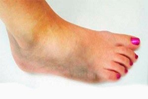 Natopeshi a lábakban a cukorbetegség kezelése