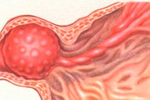 prostate cancer forum canada prostatitis wikipedia español