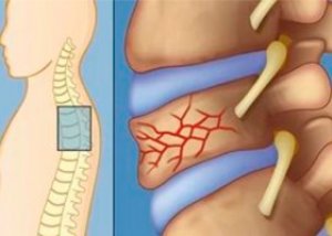 a mellkasi gerinc csontritkulása)