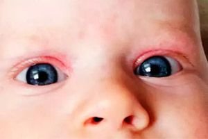 piros szem babáknál
