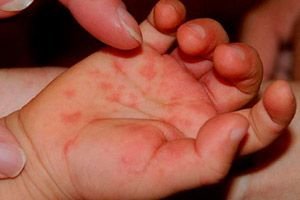 Vírusok okozta bőrbetegségek Vörös foltok a tenyéren, mint kezelni