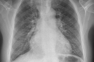 A pulmonális hypertonia