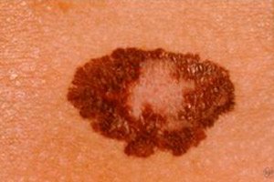 a bőrrák megismétlődik papilloma vírus hpv 31