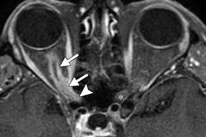 Agyi meningioma: az élet prognózisa műtét, eltávolítás, rehabilitáció, kezelés nélkül