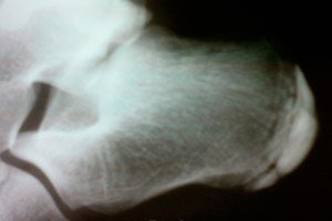 a csípőízület csontszövetének helyreállítása ízületi gyulladás és ízületi gyulladás a lábujjak kezelésében