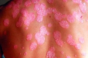 Pikkelysömör (psoriasis) tünetei, kezelése