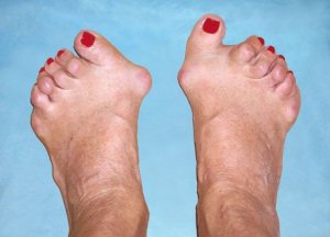 a lábak ízületeinek rheumatoid arthritis