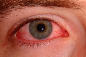 Korunk betegsége a száraz szem