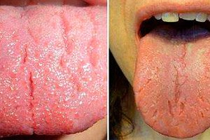 férgek és repedések a nyelvben hogyan lehet eltávolítani a jódot a férgektől