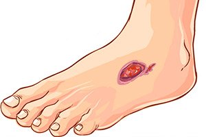 kezelése trofikus fekélyek a lábát a cukorbetegség 2 es cukorbetegség tünetei