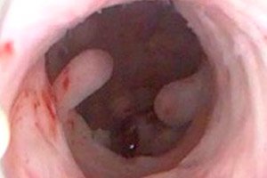 endometrium polip és fogyás