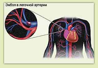 Tüdőembólia és mellkasi fájdalmak bal oldalon
