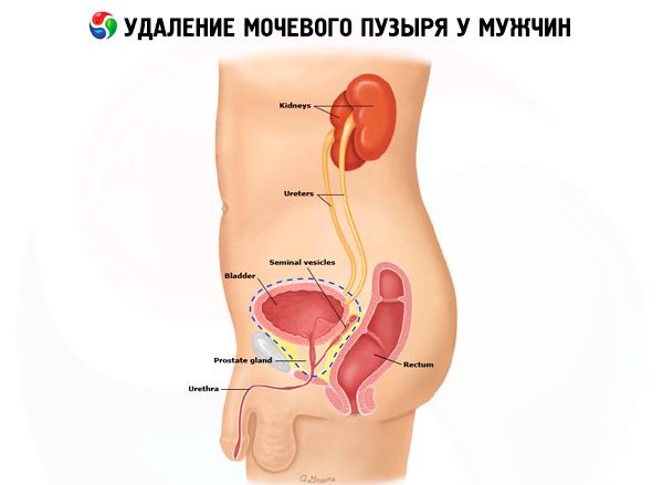 Húgycsövön keresztüli (endoszkópos) prosztata részleges eltávolítás (TURP) | Urológiai klinika