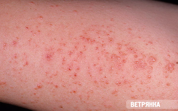 Kitörések a bőrön vörös foltok formájában hólyagokkal. Kiütés a lábakon - Tünetek
