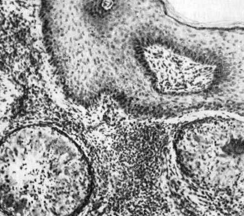 Patogének chromoblastomycosis